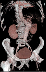 Abdominal Aortic Aneurysm (AAA) With Extensive Thrombus in Wall - CTisus CT Scan