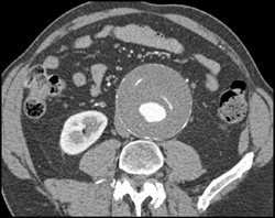 Abdominal Aortic Aneurysm (AAA) With Evidence of Prior Dissection - CTisus CT Scan