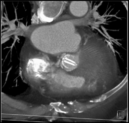 St Jude Valve - CTisus CT Scan