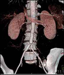 Stenosis at Aortoiliac Bifurcation Due to Vasculitis - CTisus CT Scan