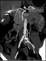 Stenosis at Aortic Bifurcation Due to Vasculitis - CTisus CT Scan