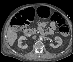 Diseased Aorta - CTisus CT Scan