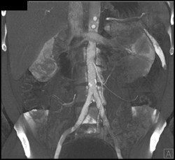 Stenosis of IMA Origin - CTisus CT Scan