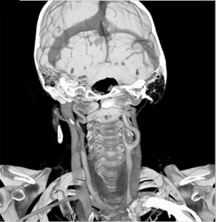 Arterial and Venous Anatomy - CTisus CT Scan