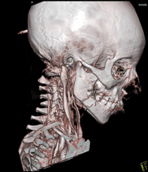 Jugular Vein in MIP and VRT - CTisus CT Scan