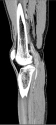 Popliteal Artery - CTisus CT Scan