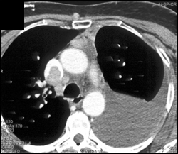 SVC Thrombosis - CTisus CT Scan