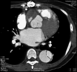 Aortic Dissection - CTisus CT Scan