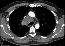 SVC Syndrome With Liver Metastases - CTisus CT Scan