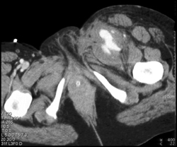 Pseudoaneurysm - CTisus CT Scan