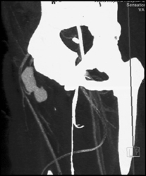 Pseudoaneurysm - CTisus CT Scan