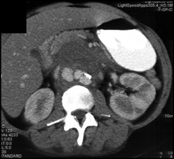 Mycotic Pseudoaneurysm - CTisus CT Scan