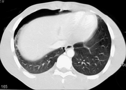 Liver Laceration and Pneumothorax - CTisus CT Scan