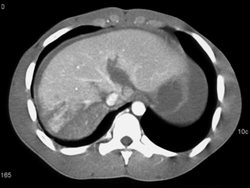 Liver Laceration W/o IVC Injury - CTisus CT Scan