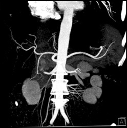 VRT and MIP Showing Advantage of VRT in Showing Splenic Artery - CTisus CT Scan