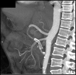 Stent in Celiac Artery With Graft - CTisus CT Scan