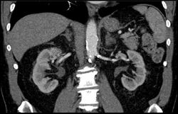 Plaque in Renal Artery - CTisus CT Scan