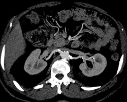 Clacified Plaque in Renal Artery - CTisus CT Scan