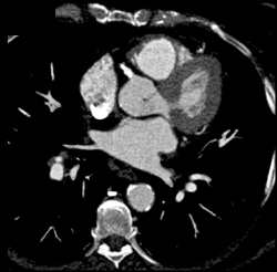 Diseased Right Coronary and LAD - CTisus CT Scan