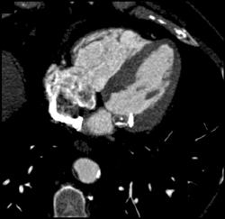 Diseased LAD - CTisus CT Scan