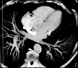 Diseased LAD - CTisus CT Scan