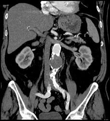 Abdominal Aortic Aneurysm (AAA) - CTisus CT Scan