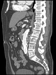 Abdominal Aortic Aneurysm (AAA) - CTisus CT Scan