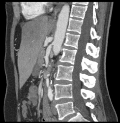 Stenosis SMA and Celiac Artery - CTisus CT Scan