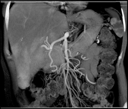 Stenosis of SMA and Celiac Artery With Flow Changes in the Liver - CTisus CT Scan