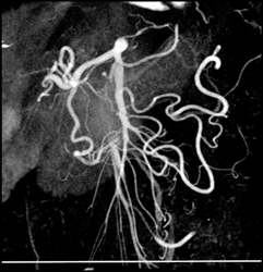 Mesenteric Collateral Flow - CTisus CT Scan