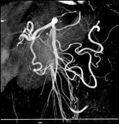 VRT and MIP of the Mesenteric Vessels - CTisus CT Scan