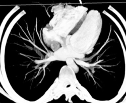 Coronary CT Angiogram - CTisus CT Scan