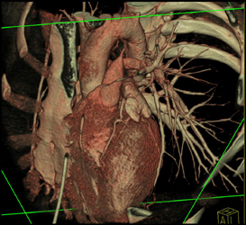 Normal Coronary Arteries - CTisus CT Scan