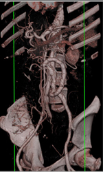 Collateral Vessels With Graft Bypass - CTisus CT Scan