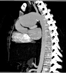 Ductus Aneurysm - CTisus CT Scan