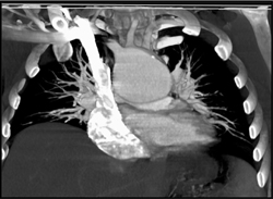 Ductus Aneurysm - CTisus CT Scan