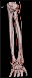 Normal CT Angiogram of the Arm - CTisus CT Scan