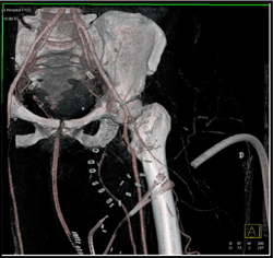 Repair of Femoral Artery Pseudoaneurysm - CTisus CT Scan