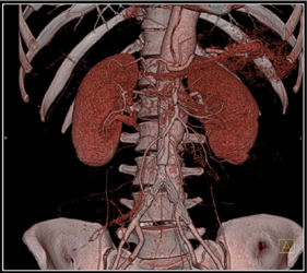 Aortic Stent Grafts - CTisus CT Scan