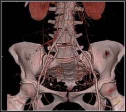 Pelvic Collateral Vessels - CTisus CT Scan