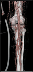 Normal CTA of the Lower Extremities - CTisus CT Scan