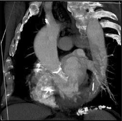 Normal St Jude Valve - CTisus CT Scan