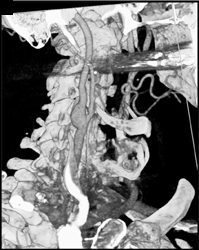 Carotid Artery Aneurysm - CTisus CT Scan