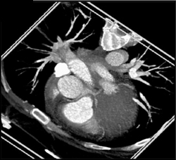 Normal Coronary CTA - CTisus CT Scan