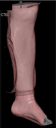 CTA Calf - CTisus CT Scan