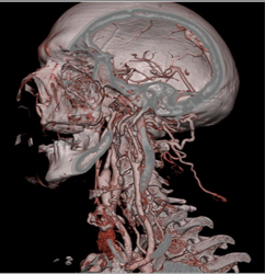 Carotid Artery Disease - CTisus CT Scan