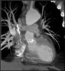 Normally Functioning Aortic Valve - CTisus CT Scan