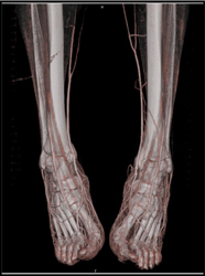 Normal CTA of the Feet - CTisus CT Scan