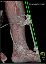 Ulcer in Ankle - CTisus CT Scan