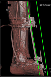 CTA With Ulcer in Ankle - CTisus CT Scan